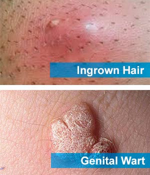 Ingrown Hair On Vagina