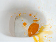 Keriorrhea Causes, Symptoms & Remedies Keriorrhea causes symptoms and remedies