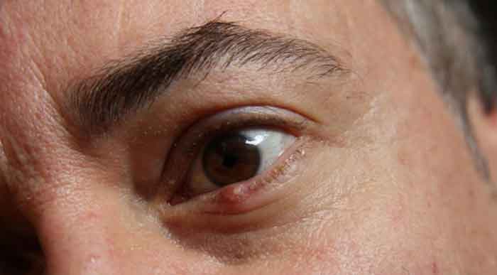 Ingrown eyelash on lower eyelid