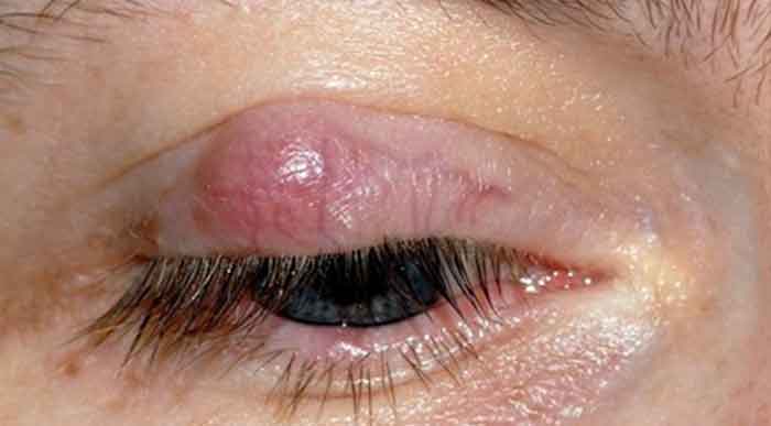Ingrown eyelash on upper eyelid