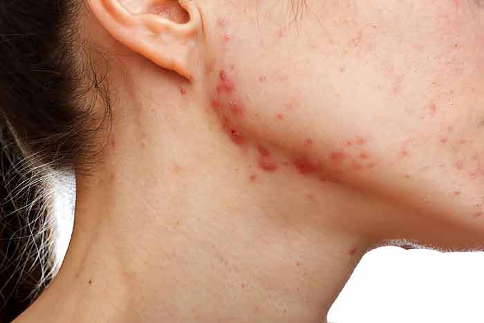 olive oil for acne scars overnight