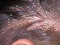 How to use Apple Cider Vinegar for Dandruff Treatment how to Treat dandruff with apple cider vinegar