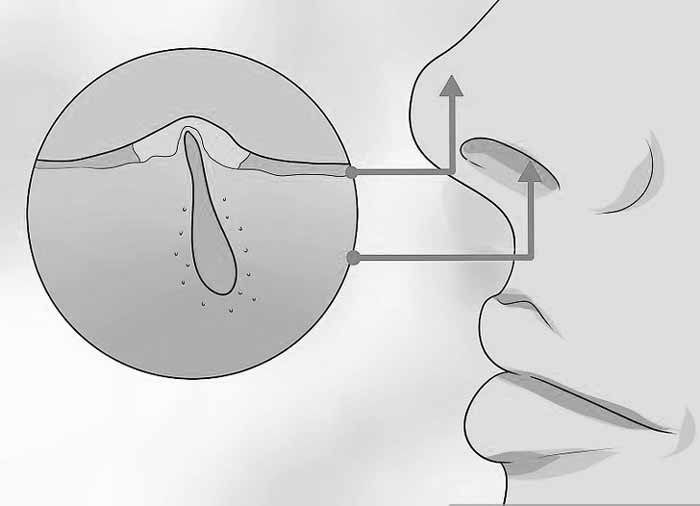 Enderezar tabique nasal casero