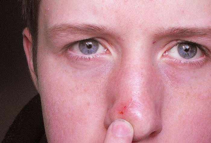 Ingrown Hair In Nose Pictures Pimple Symptoms Pluck Infection On