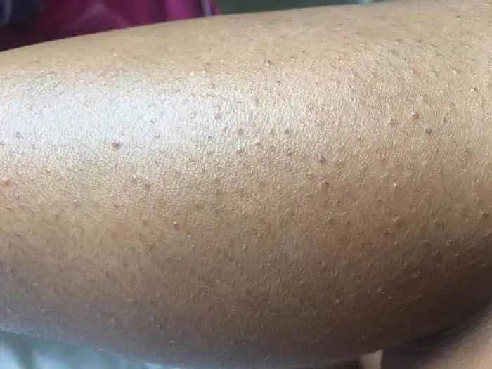 Lots of little ingrown hair on legs and thigh
