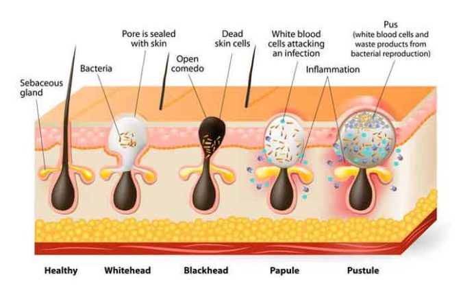 Boil vs Pimple- Differences with Pictures, Boil or Pimple?