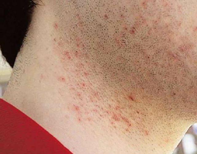 Ingrown Hair on Neckline, Back of Neck, Female, How to get rid, Treat