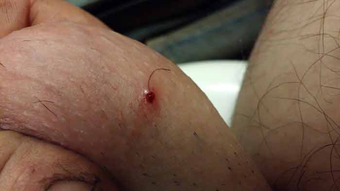 Ingrown Hair On Shaft Of Penis 105