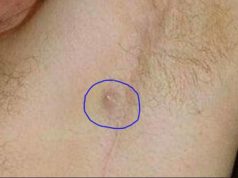 Ingrown Hair in/under Armpit-Get Rid, Lymph Node, Lump & Pictures Ingrown Armpit Hair under arm ho to get rid, symptoms-causes
