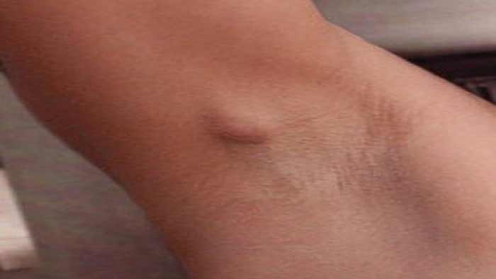 Ingrown armpit hair or lymph node