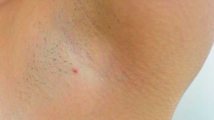 Ingrown hair in armpit picture