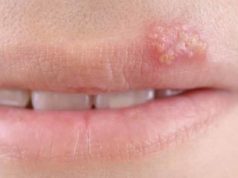 How to get Rid of a Fever Blister Immediately & Overnight tea tree oil fever blister fast heal