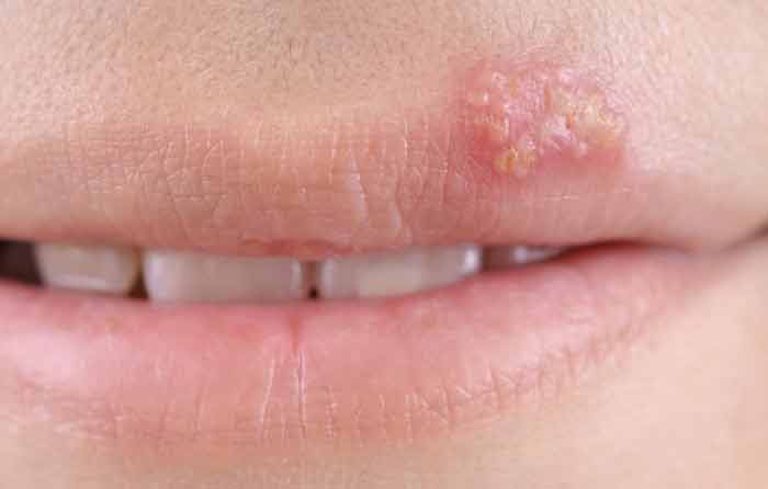 How To Get Rid Of A Fever Blister Immediately Overnight 24hours 