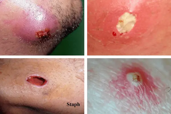 15 Best Pictures Infected Ingrown Hair Armpit : How To Get Rid Of Ingrown Hair Quickly And Safely ...
