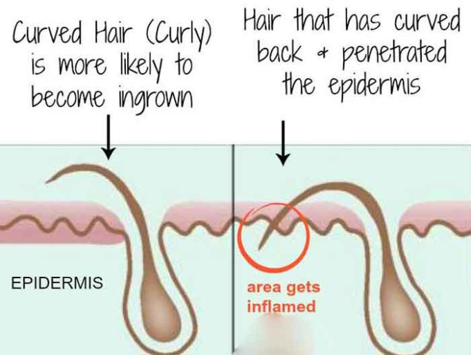 Ingrown Hair vs Herpes Ingrown Hair or HerpesWhat’s the Difference