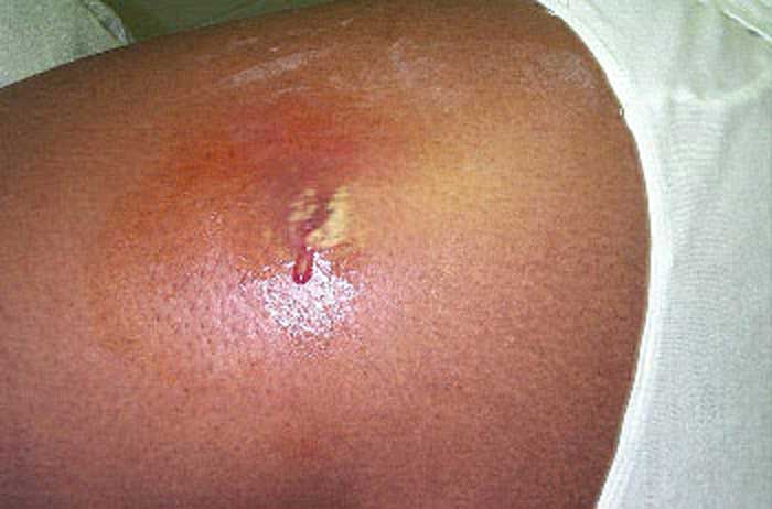 cyst boil lancing picture