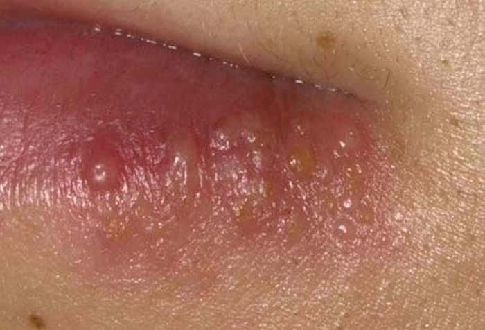 ingrown hair on vag lips pictures | Jidimakeup.com