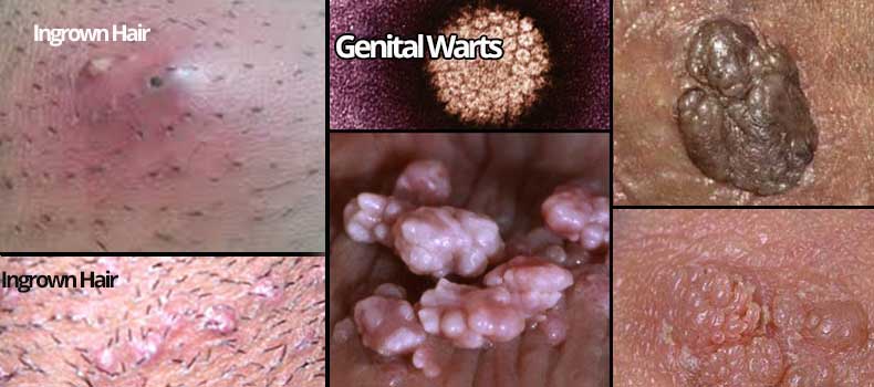 Get Rid Of Ingrown Hair On Vagina To Prevent Vaginal Boil