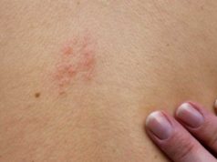 How Long does Shingles Last, Recovery Time, with Valtrex, Nerve Pain & Untreated How lond does shingles last with or without treatment?