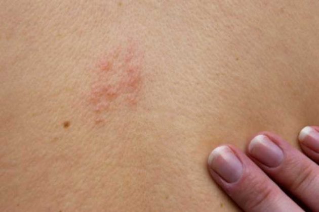 shingles-vaccine-still-scarce