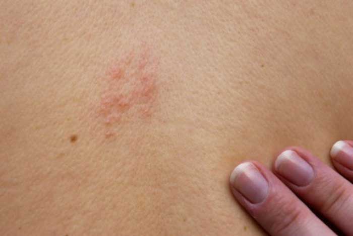 shingles-epiphany-dermatology