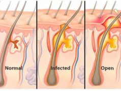 Are Boils Contagious? How are boils contagious