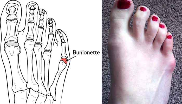 get rid of bunion pinky toe/tailor's bunion
