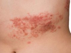 How to Cure Shingles in 3 Days-Get Rid of Shingles Fast, Quickly, Overnight how to get rid of shingles fast