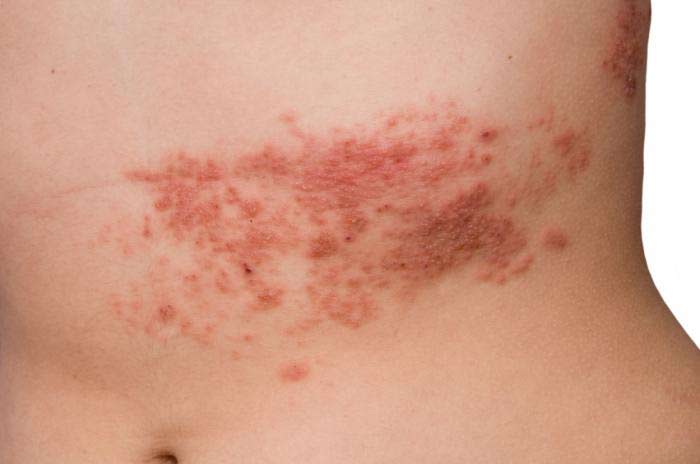 how to get rid of shingles fast