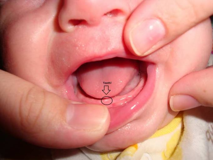 white-spots-on-gums-baby-painful-pictures-above-below-teeth-hard