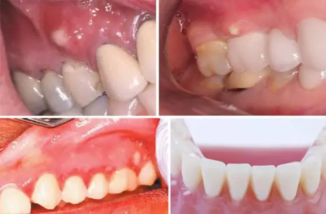 teeth translucent pain gums swollen