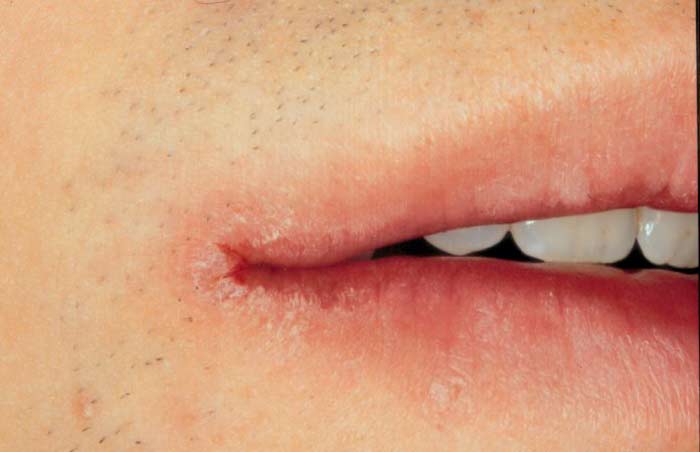 fordyce spots on corner of mouth