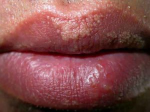 Fordyce Spots, How to Get Rid, Home Remedies, Causes, Symptoms + Pictures