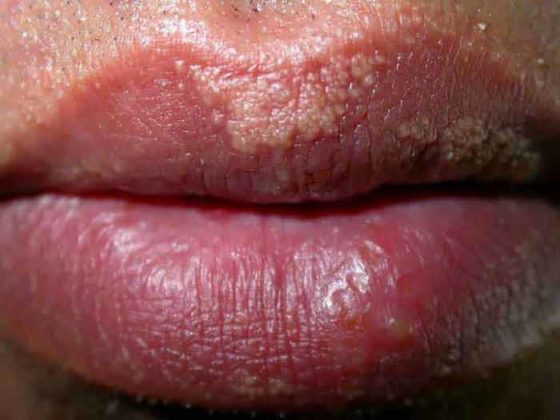 Fordyce Spots How To Get Rid Home Remedies Causes Symptoms Pictures
