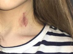 hickey give last yourself neck hickeys arm does someone meaning hurt