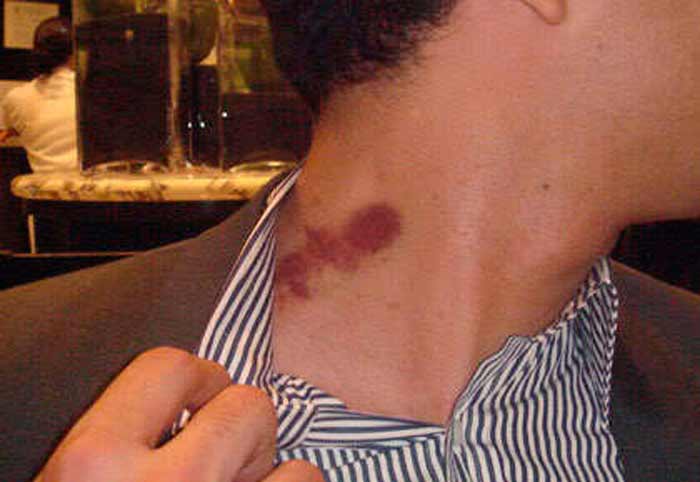 hickey on neck picture