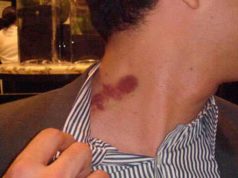 How to give Yourself or Someone a Good Hickey on Arm & Neck how to give yourself someone a hickey perfectly