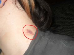 How to Hide and Get Rid of Hickeys Fast how to hide get rid of a hickeys