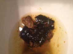 Black Tarry Stool Causes, Indications &amp; Symptoms - CureHows