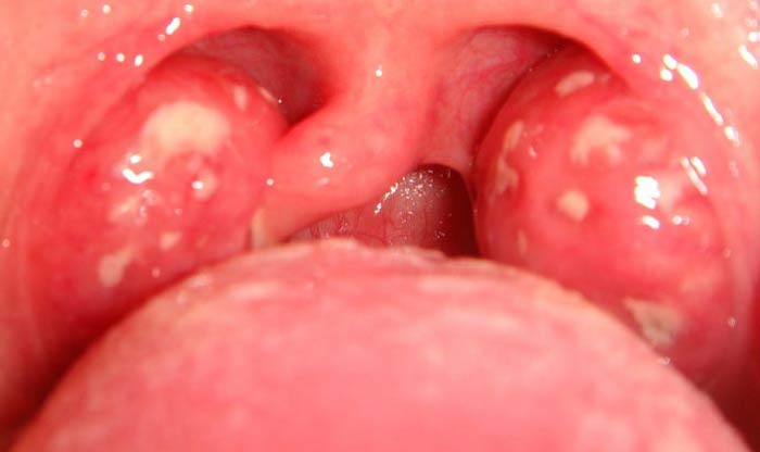 How to get rid of White Pus on Tonsils CureHows