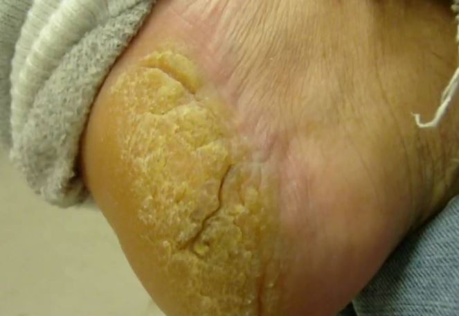 Calluses can cause yellow feet