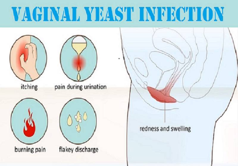 Why Do I Get Recurring Yeast Infections After Period Curehows