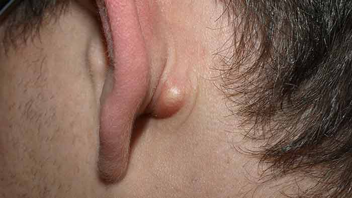 Bumps Behind Ears lobe causes treatment