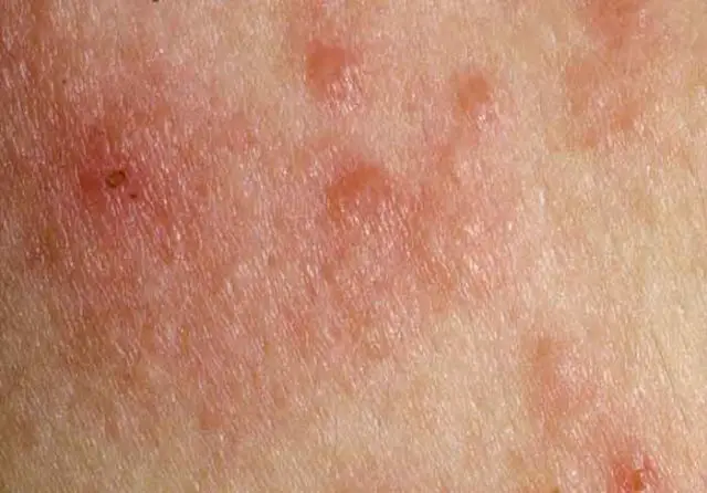 armpit-rash-pictures-causes-fungi-heat-treatment-curehows