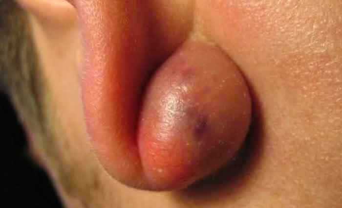 Sebaceous cyst lump