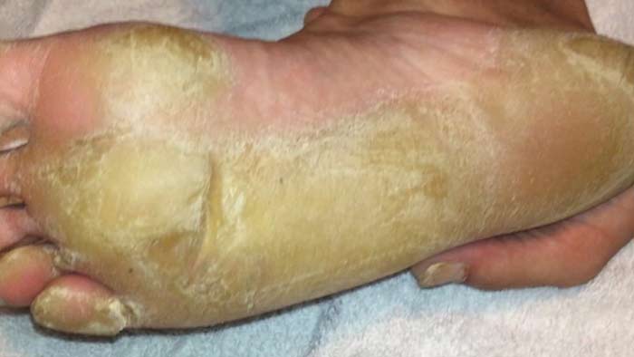 Bottom of foot yellow causes, symptoms, treatment at home