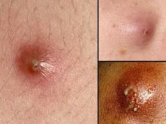 Infected Pimple- Yeast, Staph, Get Rid, Face, Nose & Leg infected pimple pictures-causes, symptoms-treat