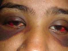 How to get rid of Raccoon Eyes How to deal with racoon/pand eyes