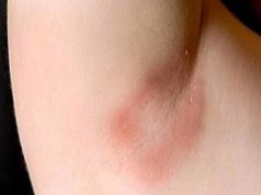 Armpit Rash,Pictures, Causes(Fungi, Heat) & Treatment rash under armpit causes types-get-rid