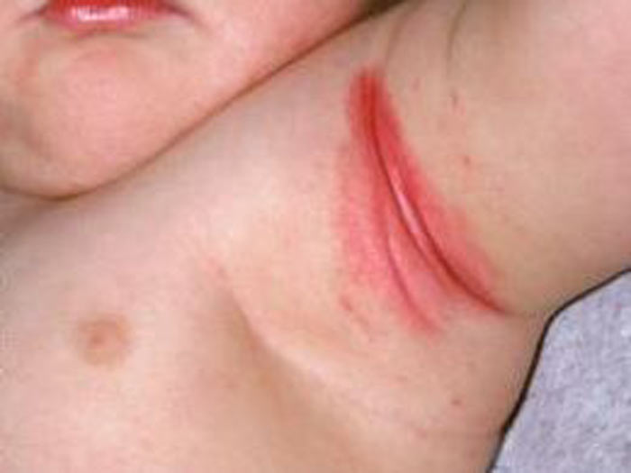 rash under armpit-baby